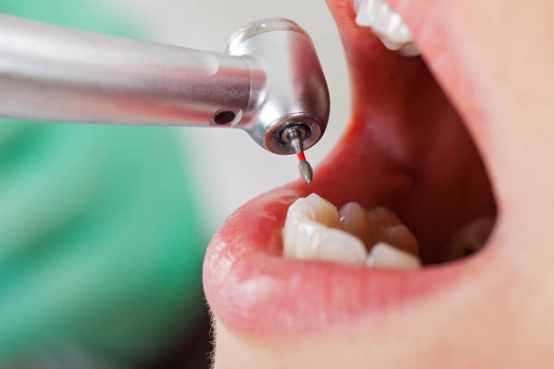 Best Emergency Tooth Extraction in Mount Pleasant, MI